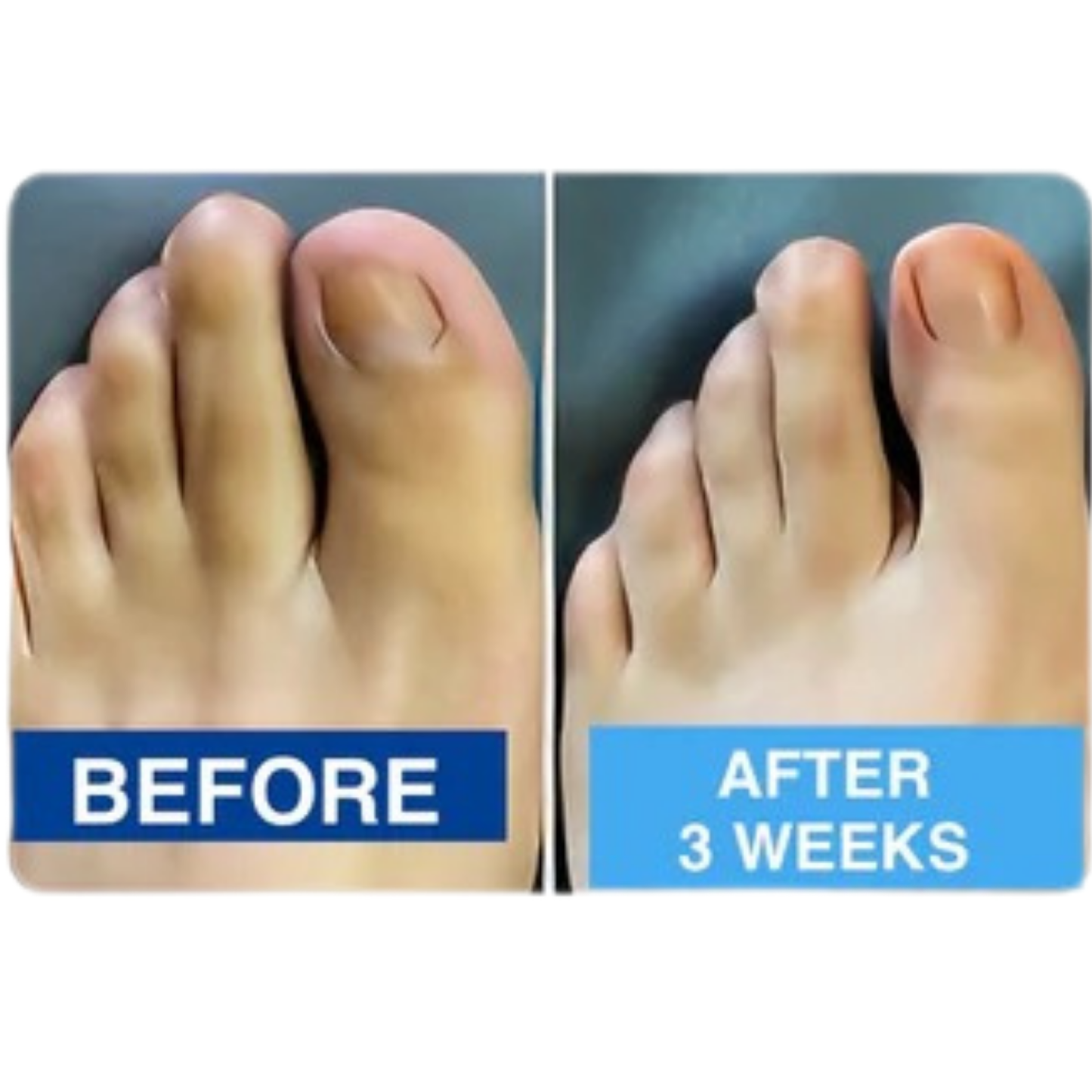 Nuvevia™ Anti-Fungal Nail Repair Patches