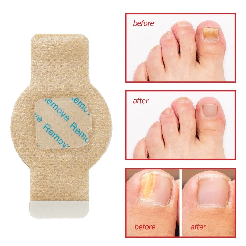 Nuvevia™ Anti-Fungal Nail Repair Patches