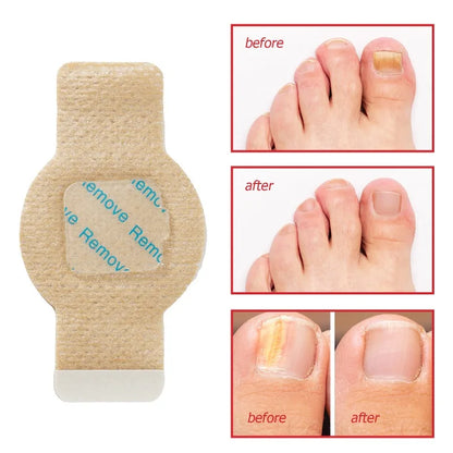 Nuvevia™ Anti-Fungal Nail Repair Patches