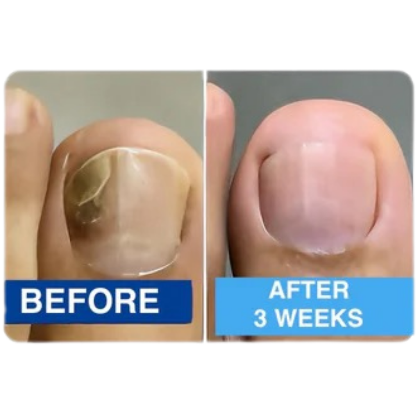 Nuvevia™ Anti-Fungal Nail Repair Patches